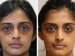 Eyelid Surgery/ Blepharoplasty in Mumbai | Dr. Hemang Sanghvi