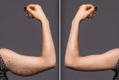 Arm Liposuction & Arm Skin Removal by Dr. Hemang Sanghvi