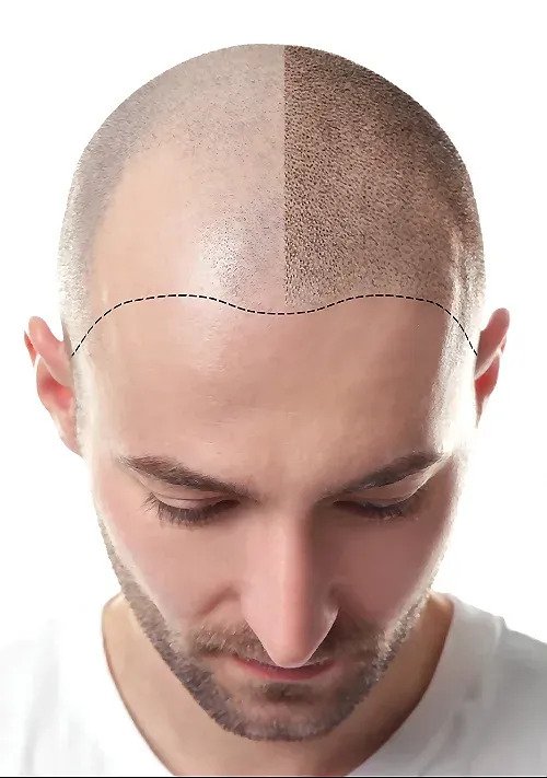 Scalp Micropigmentation in Mumbai | Hair Transplant Surgeon Dr. Hemang Sanghvi